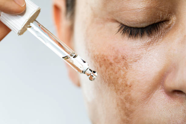 Melasma