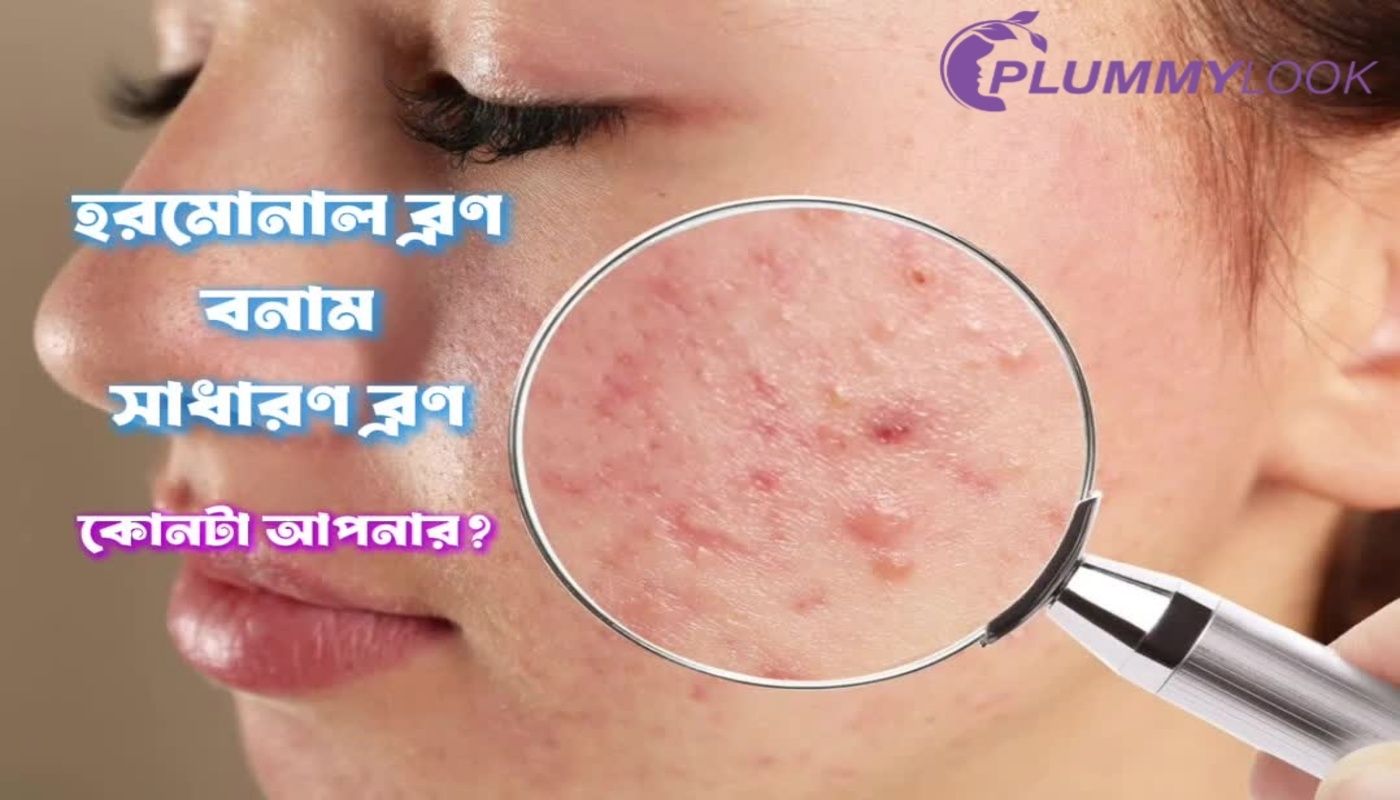 হরমোনাল ব্রণ vs সাধারণ ব্রণ — কোনটা আপনার? সহজভাবে বুঝে নিন
